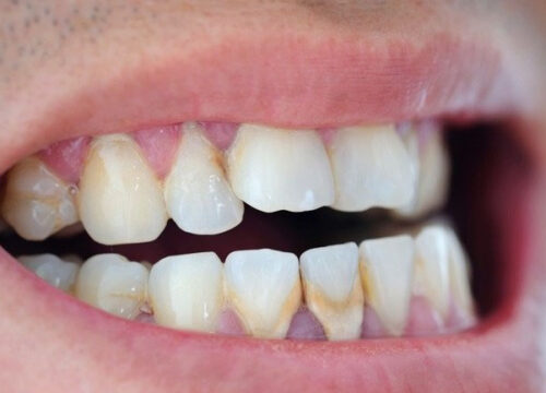 Enam Cara Menghilangkan Kerak Gigi yang Efektif