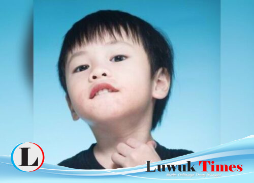 Ini Sembilan Penyakit Kulit pada Anak yang Sering Terjadi