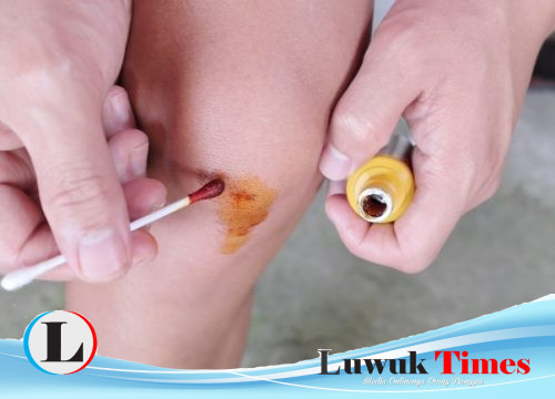 Cara Merawat Luka Terbuka Agar tidak Kena Infeksi